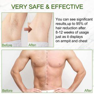 IPL Laser Hair Removal, 500000 Flashes Painless Permanent Hair Removal for Women